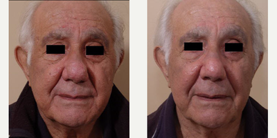 CO2 Laser before and after photo