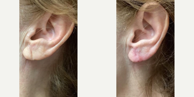 Dermal Fillers before and after photo