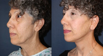 Facelift before and after photo