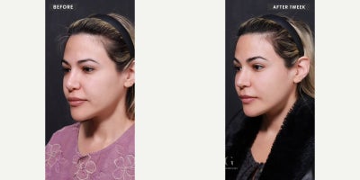 Facelift before and after photo