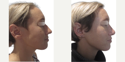 Septoplasty before and after photo