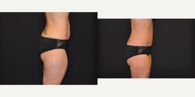 Tummy Tuck before and after photo