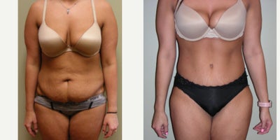 Tummy Tuck before and after photo