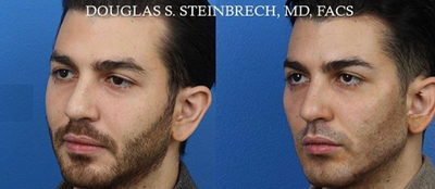 Botox before and after photo