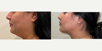 Chin Liposuction before and after photo