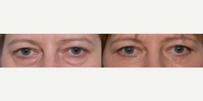 Eyelid Surgery before and after photo