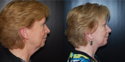 Facelift before and after photo
