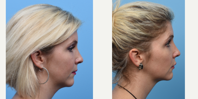 Kybella before and after photo