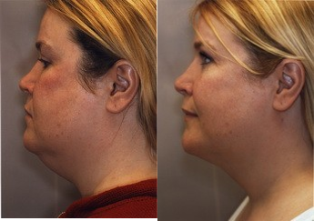 Liposuction before and after photo