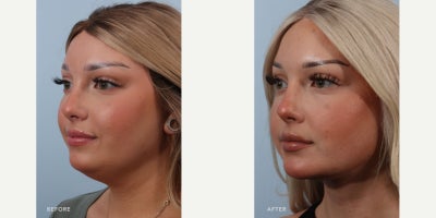 Neck Lift before and after photo