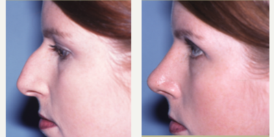Rhinoplasty before and after photo