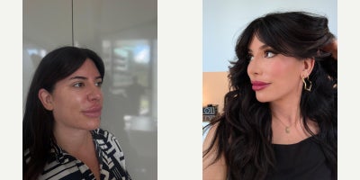 Rhinoplasty before and after photo