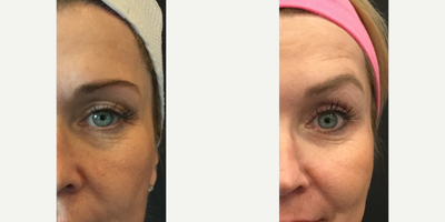 Ultherapy before and after photo