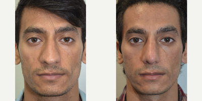 Asian Rhinoplasty before and after photo