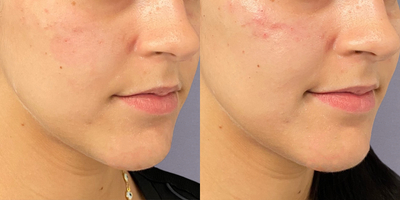 Cheek Fillers before and after photo
