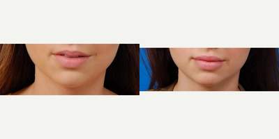 Dermal Fillers before and after photo