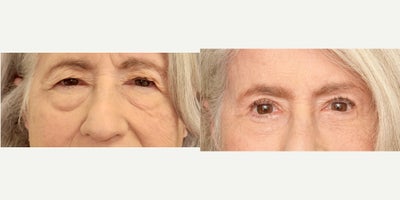 Double Eyelid Surgery before and after photo