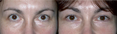 Eyelid Surgery before and after photo
