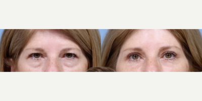 Eyelid Surgery before and after photo