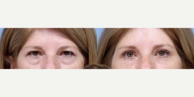 Eyelid Surgery before and after photo
