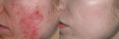 Fraxel Laser before and after photo
