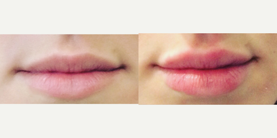 Lip Fillers before and after photo