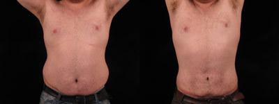 Liposuction before and after photo