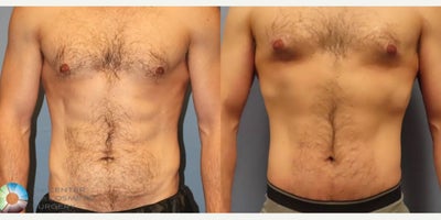 Male Tummy Tuck before and after photo