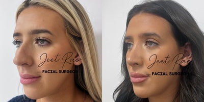 Rhinoplasty before and after photo