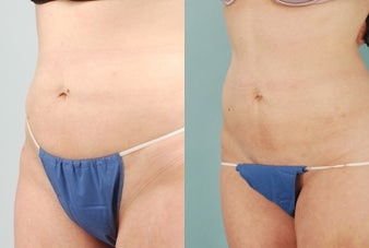 Smart Lipo before and after photo