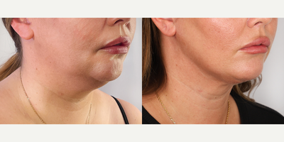 Vaser Liposuction before and after photo