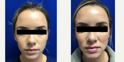 Voluma before and after photo