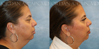 Facelift before and after photo