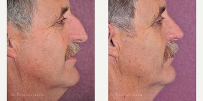 Rhinoplasty before and after photo