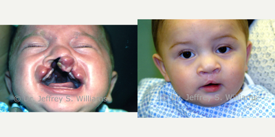 Cleft Lip And Palate Repair before and after photo