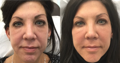 Dermal Fillers before and after photo
