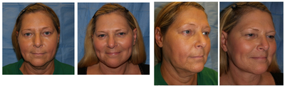 Facelift before and after photo