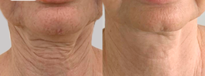 Fractora RF before and after photo