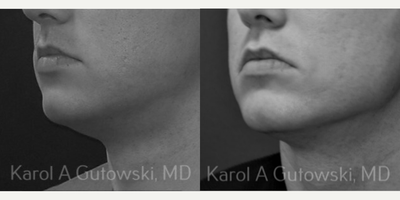Liposuction before and after photo