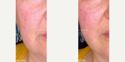 Nonsurgical Facelift before and after photo