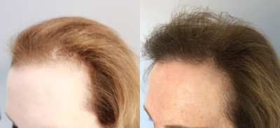 PRP for Hair Loss before and after photo