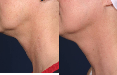 Fraxel Laser before and after photo