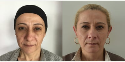 Juvederm before and after photo