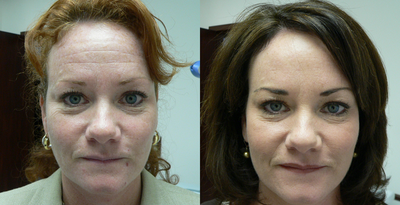 Botox before and after photo