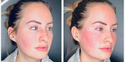 Cheek Fillers before and after photo