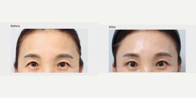 Facelift before and after photo