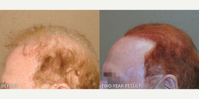 FUE Hair Transplant before and after photo