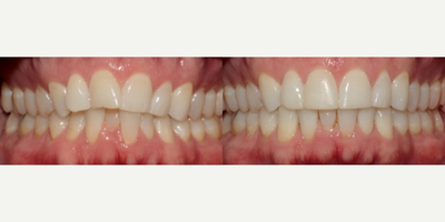 Invisalign before and after photo