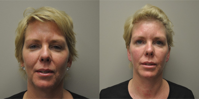 Juvederm before and after photo