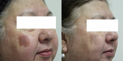 Skin Rejuvenation before and after photo